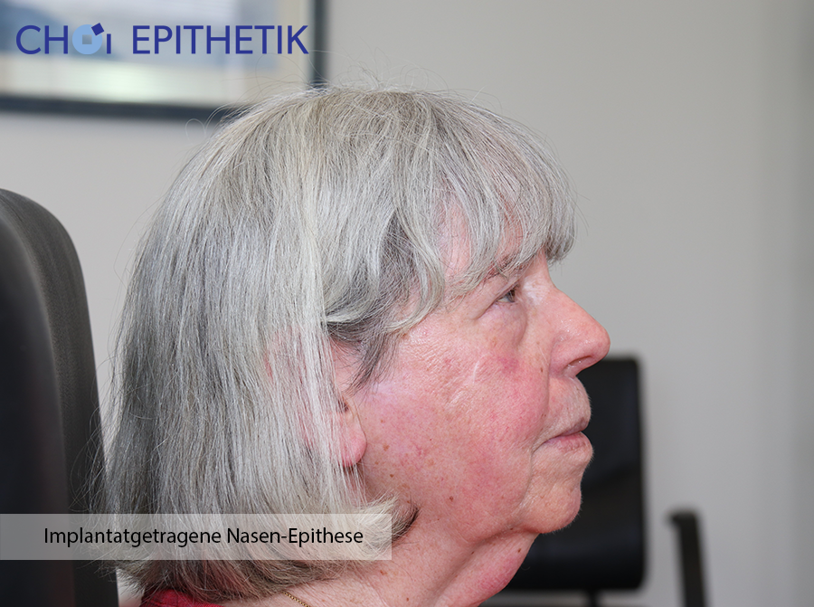 Implantatgetragene Nasenepithese