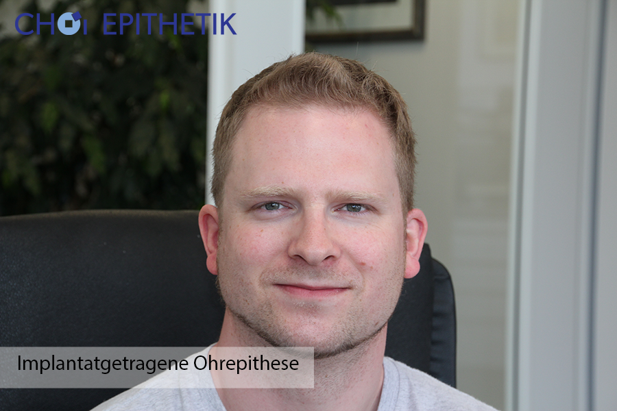 Implantatgetragene Ohrepithese